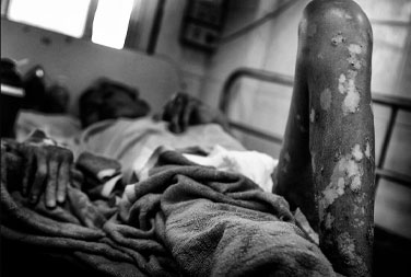 Aids Patient